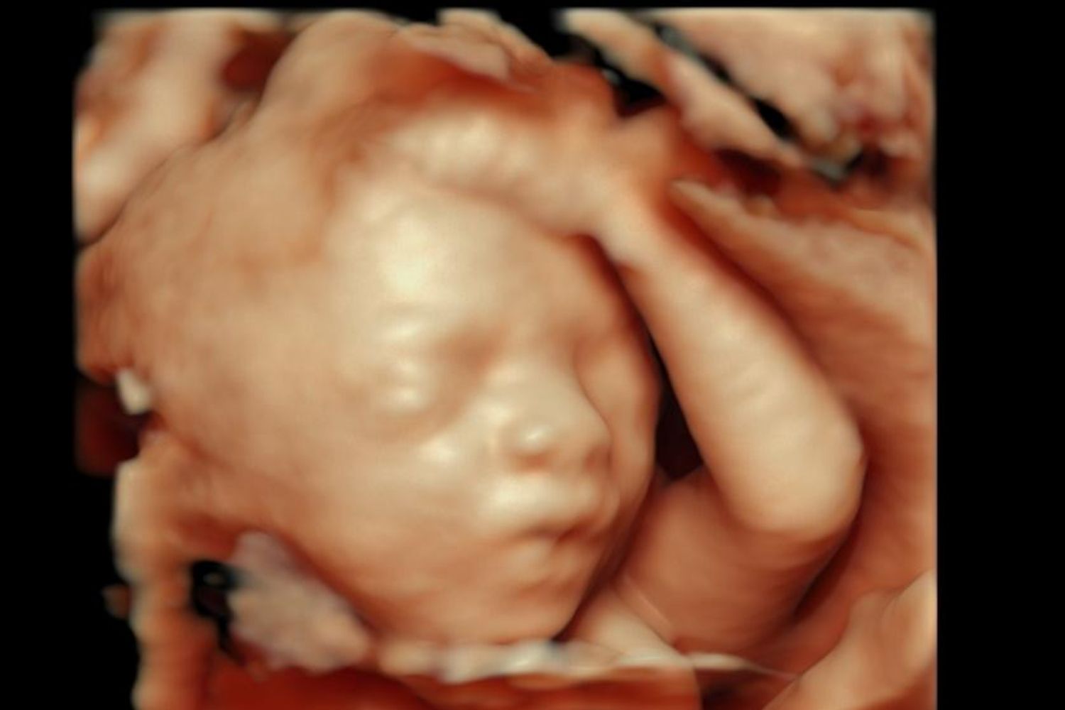 Ultrasonido 4D bebé lateral - Voluson E10